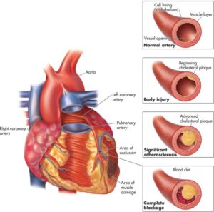 Atherosclerotic Heart Disease