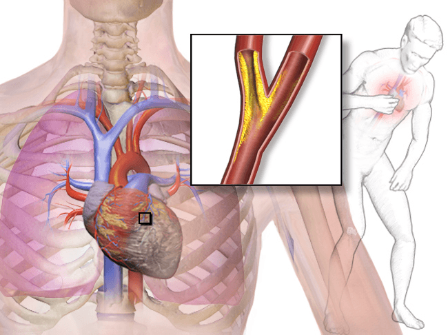 Angina Pectoris