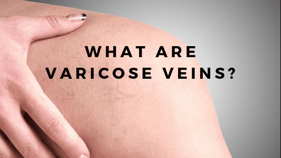 what are varicose veins