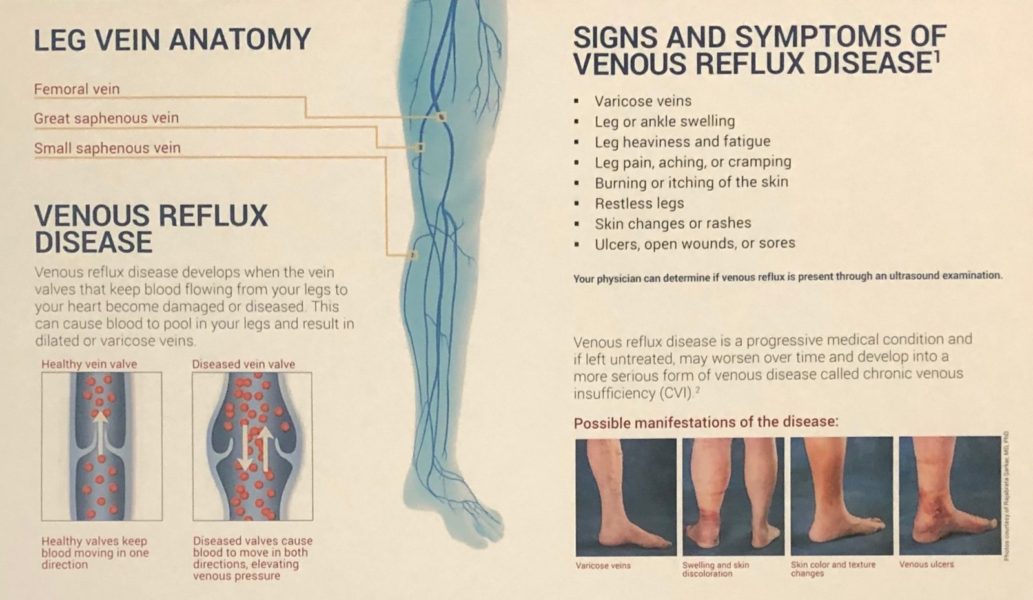 VARICOSE VEINS