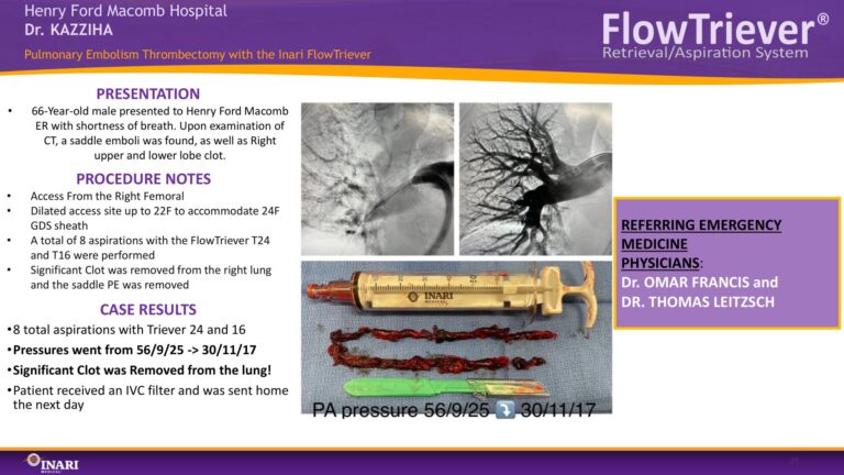 extracting large clots
