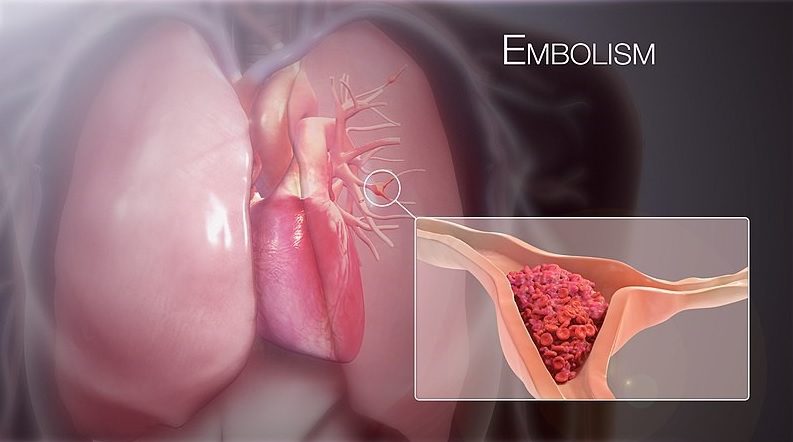 Pulmonary Embolism