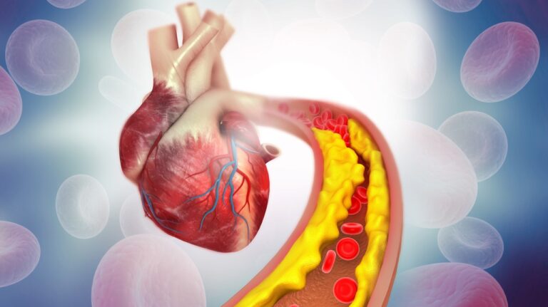 Aortic Atherosclerosis – Michigan’s Silent Artery Threat