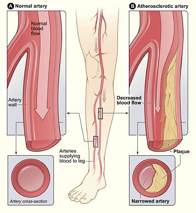 Cerebrovascular Disease & Peripheral Artery Disease (PAD) – Trusted Vascular Care in Michigan
