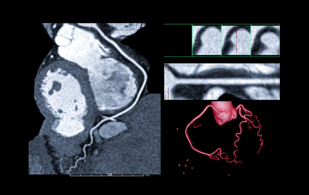 Cardiac CT